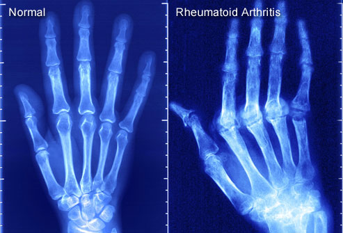 Normal palm vs Rheumatoid Arthritis