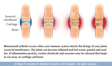 Rheumatoid arthritis (RA) is an autoimmune disease where the body's immune system attacks normal joint tissues, causing inflammation of the joint lining